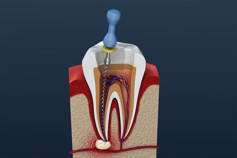 Endodontologie Wurzelkanalbehandlung