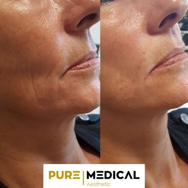 Hyaluron Behandlung Gunstig Bei Pure Medical Aesthetic