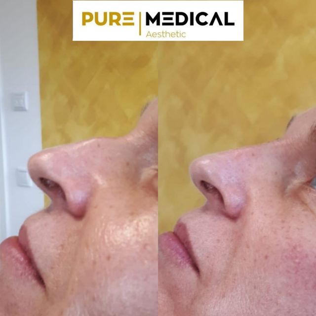 Nasenkorrektur Ohne Op Pure Medical Aesthetic