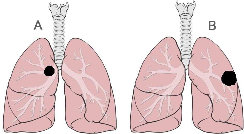 Chirurgie thoracique Dijon Besançon - cancer du poumon