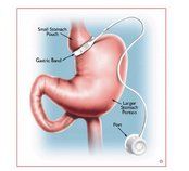 Gastric Band