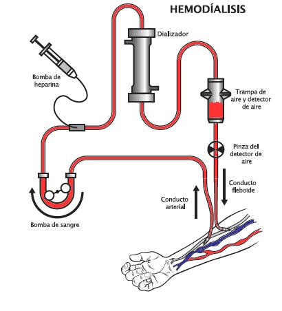 Hemodiálisis