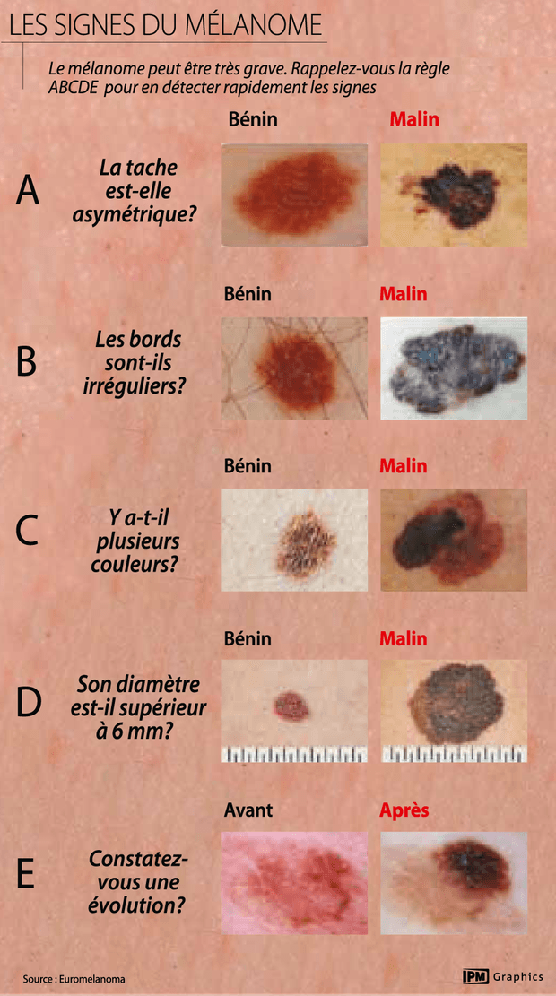 Mélanome, de nouvelles recomandantions