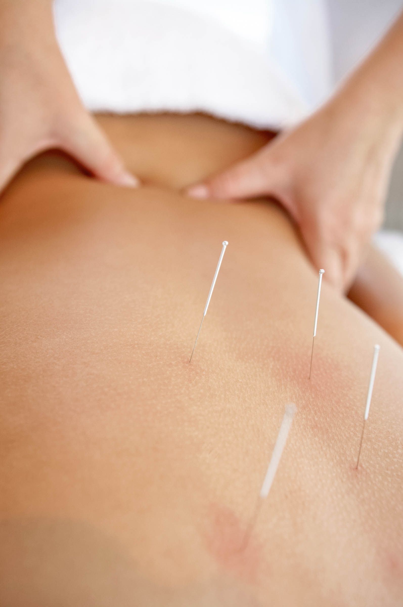 Akupunktur am Rücken