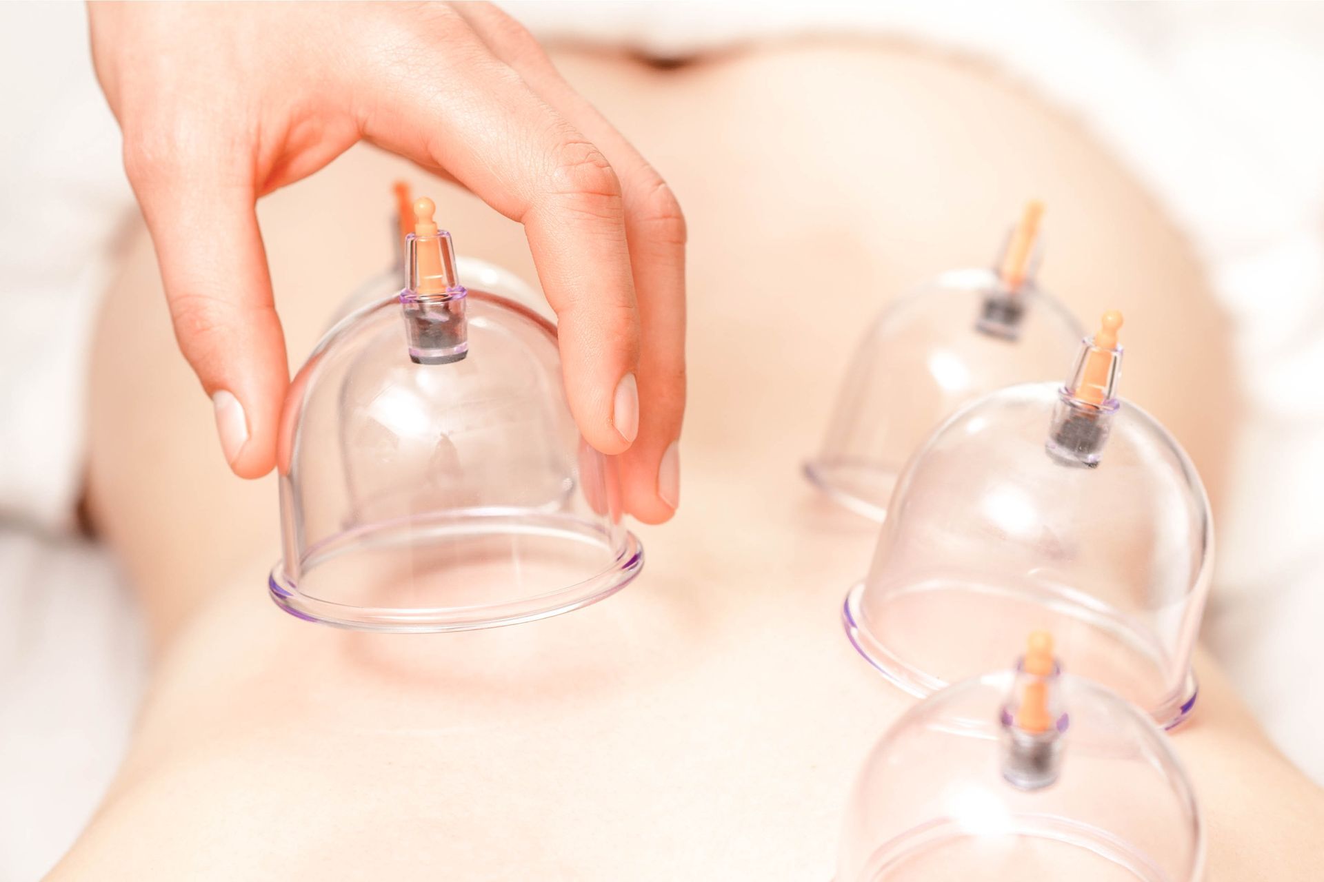 Therapieverfahren Schröpfen Rücken