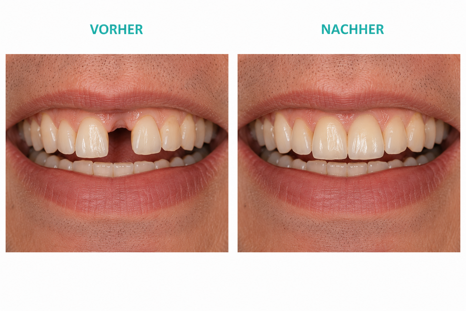 Frontzahnimplantat – natürliche Ästhetik bei sichtbarer Zahnlücke Vorher-Nachher Frontzahnimplantat bei Zahnlücke im sichtbaren Bereich in Leichlingen bei Dr. Bodenhausen