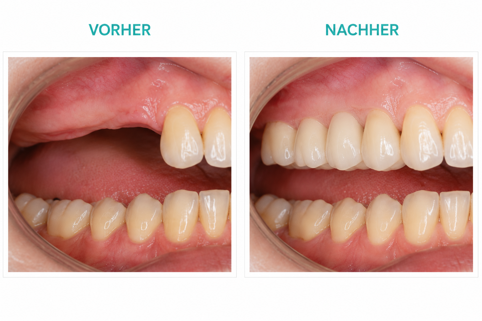 Implantatgetragene Brückenversorgung im rechten Oberkiefer – festsitzend, funktionell und ästhetisch rehabilitiert.r Aligner-Therapie – funktionell verbessert, ästhetisch harmonisiert und präzise geplant. Vorher-Nachher Implantatbrücke bei Freiendsituation im rechten Oberkiefer in Leichlingen bei Dr. Bodenhausen.