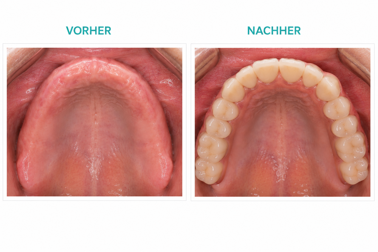 Festsitzende Komplettversorgung des zahnlosen Oberkiefers – neue Stabilität, Funktion und Lebensqualität.r Aligner-Therapie – funktionell verbessert, ästhetisch harmonisiert und präzise geplant. Vorher-Nachher festsitzende Implantatversorgung bei zahnlosem Oberkiefer in Leichlingen bei Dr. Bodenhausen.