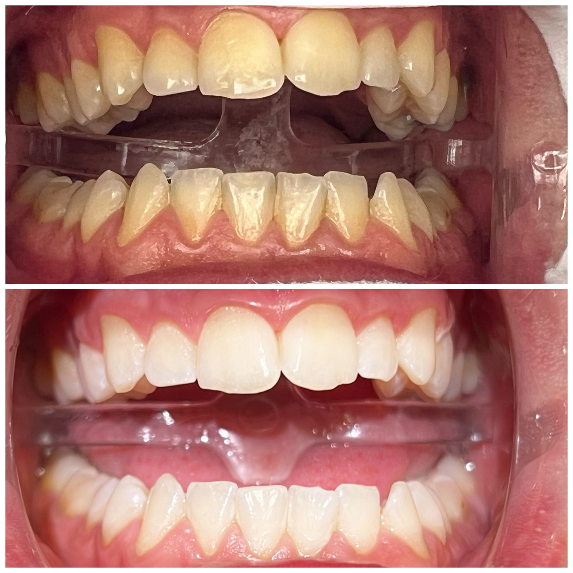 Ergebnisse nach 3 Bleachingdurchgängen