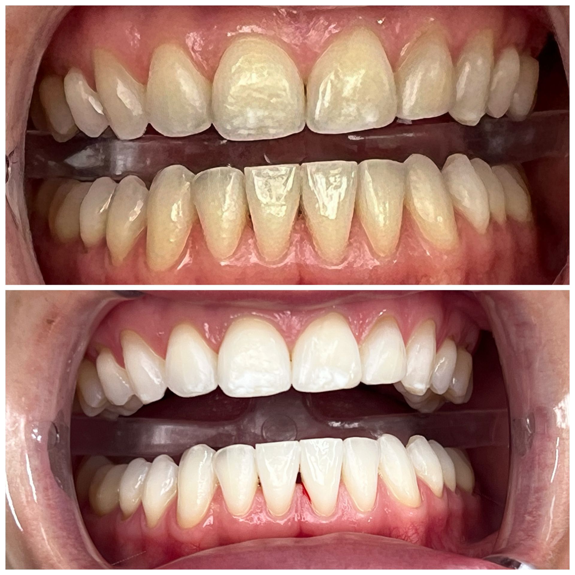 4 Durchgänge mit Lydenti Bleachingprodukt