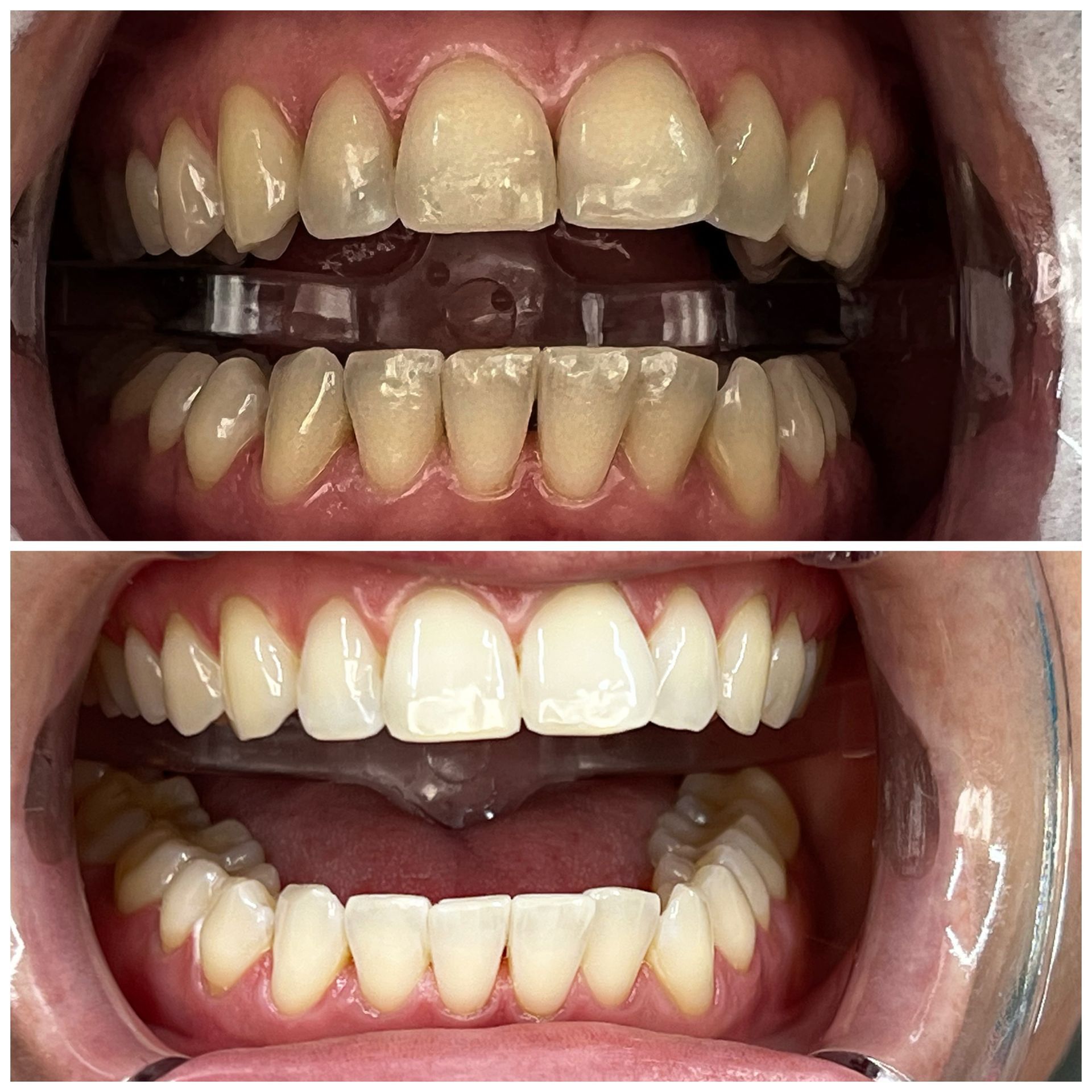 Wasserstoffperoxid zieht alle Farbeinlagerungen aus dem Schmelz