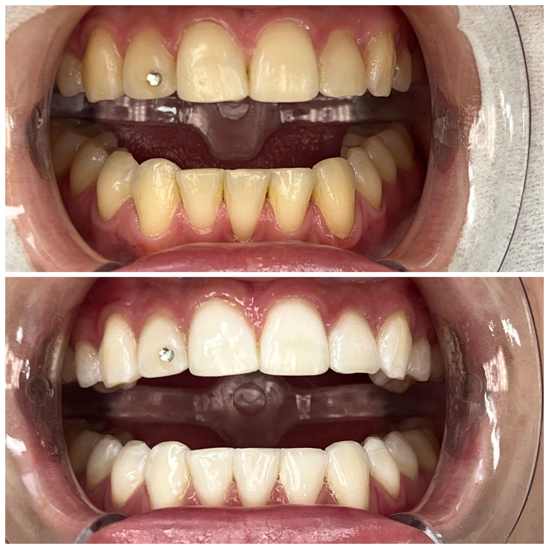 Auch mit Zahnschmuck, kein Problem