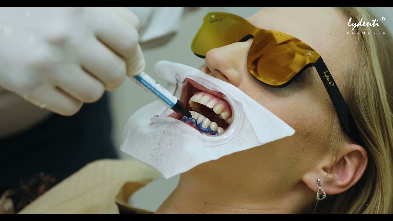 Blanqueamiento Dental en 60 minutos