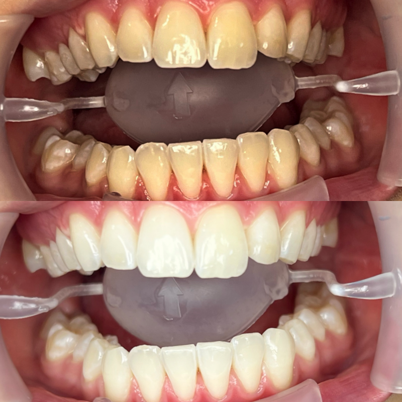 8 Nuancen heller, Patient zufrieden