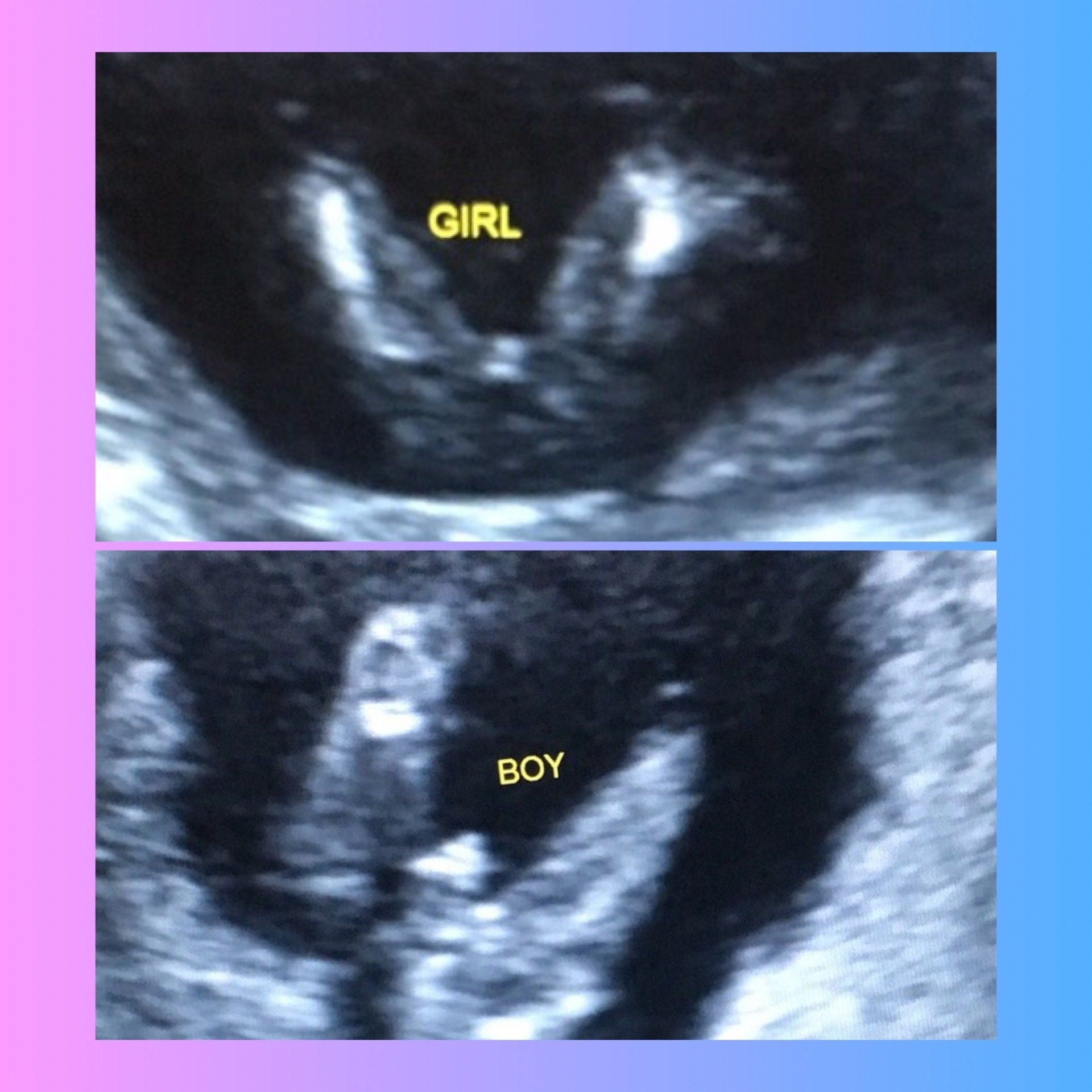 Early Stages Ultrasound Imaging Gender Reveal And 3d 4d Ultrasounds In Lakeland