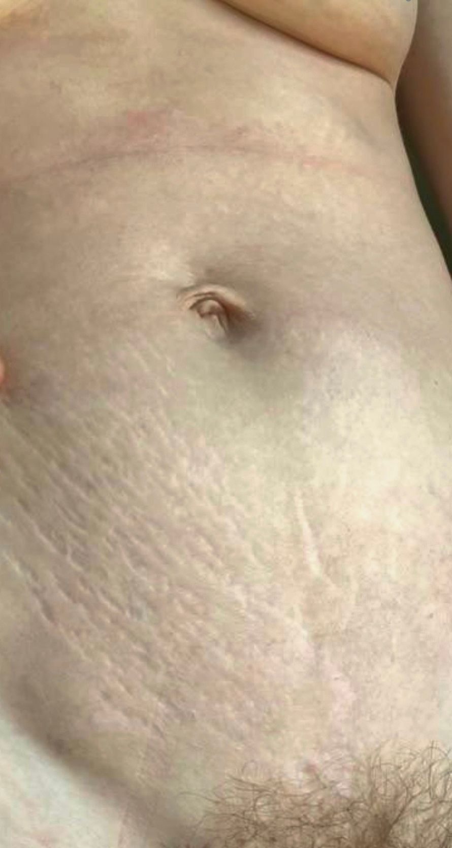 auf dem nackten Bauch einer Frau sind deutlich Schwangerschaftsstreifen zu sehen. Das Bild strahlt Schönheit im unvollkommenen aus, die Streifen wirken besonders sexy, als Zeugen von Leben und Freude. Das Bild symbolisiert Wabi Sabi: die Schönheit des Natürlichen.