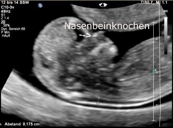 Dr Nabielek Schwangerschaft Ersttrimester Screening