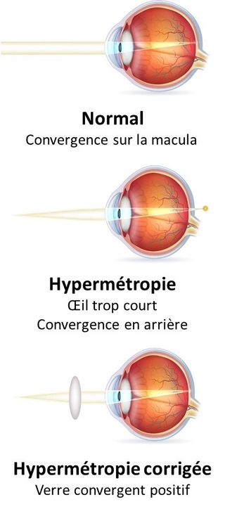 Rendez-vous Rapide En Ophtalmologie - Pole Ophtalmo Melun