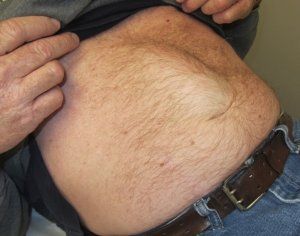 Diastasis Rect or Belly Fat?
