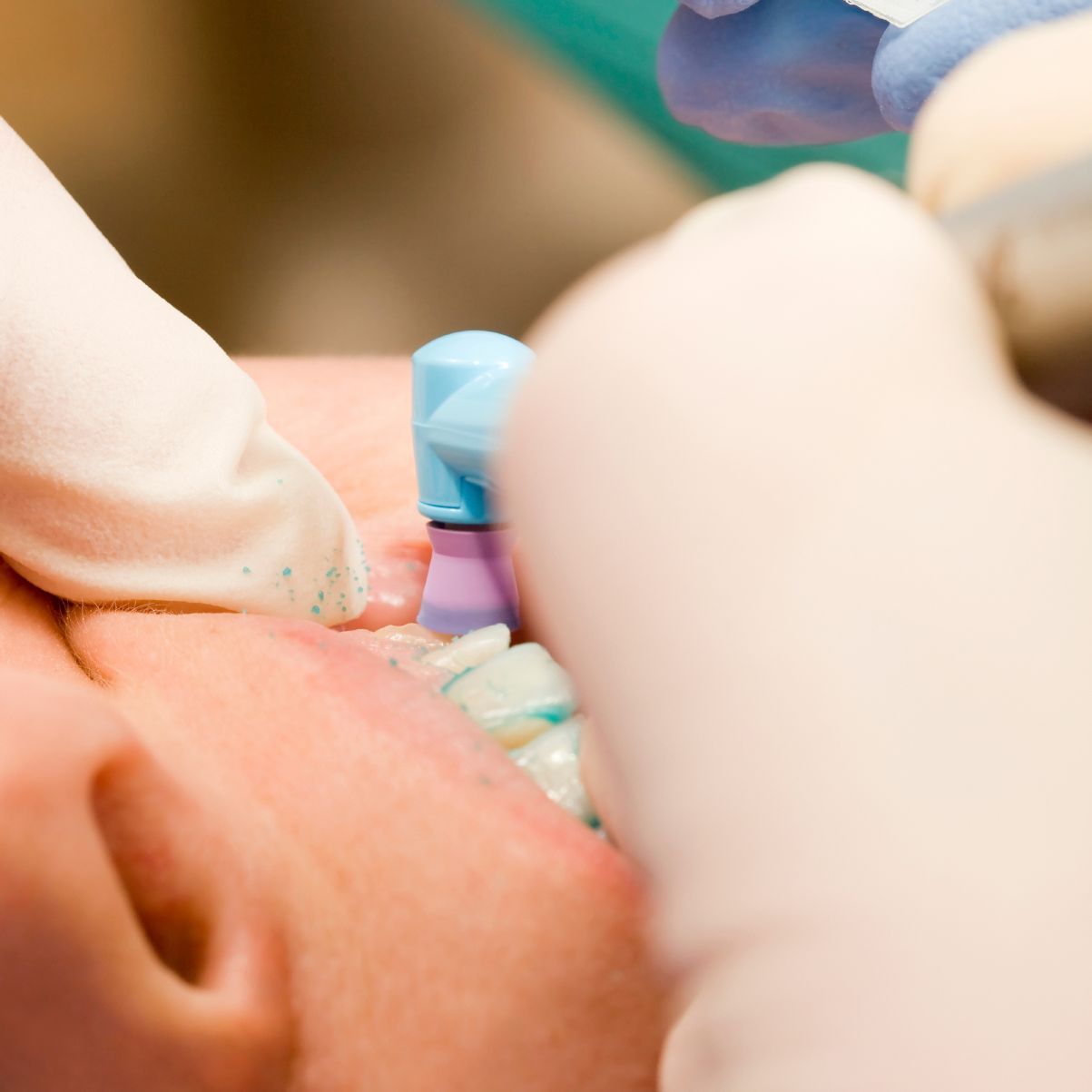 Alle Infos rund um die Professionelle Zahnreinigung