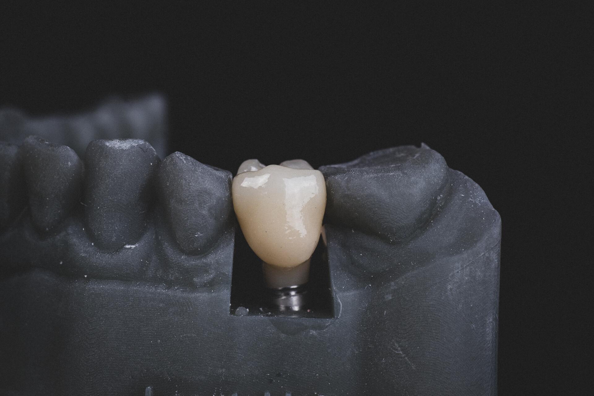 Zahnersatz auf Implantat gelagert