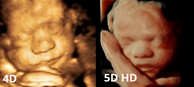 Conozca Las Diferencias Entre La Ecografia 3d 4d Y 5d