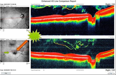 pre y post tratamiento laser moscas volantes. vitreolisis laser ultra Q reflex de Ellex