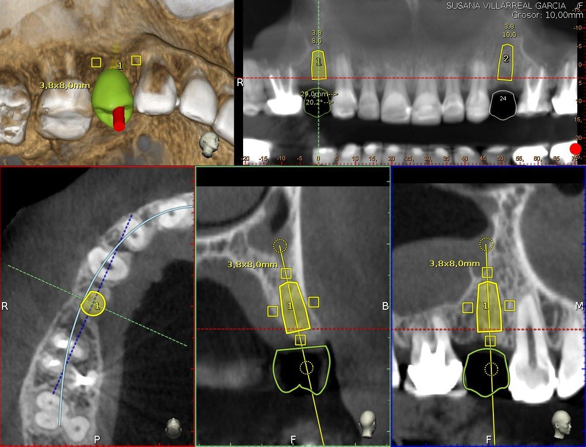 Postgrado En Implantología, Especialidad En Implantología