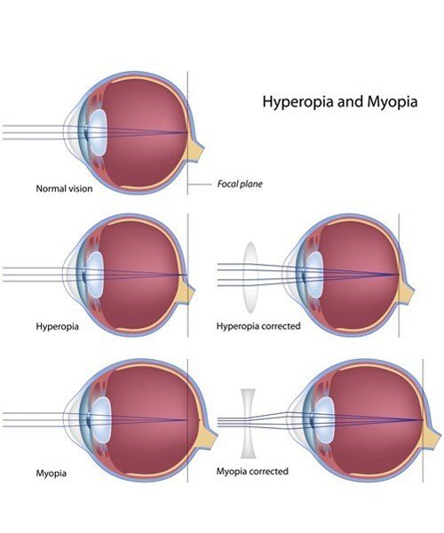 hyperopia myopia treatment