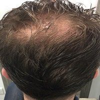 High Frequency Hair Treatment - Hair Loss Solutions London