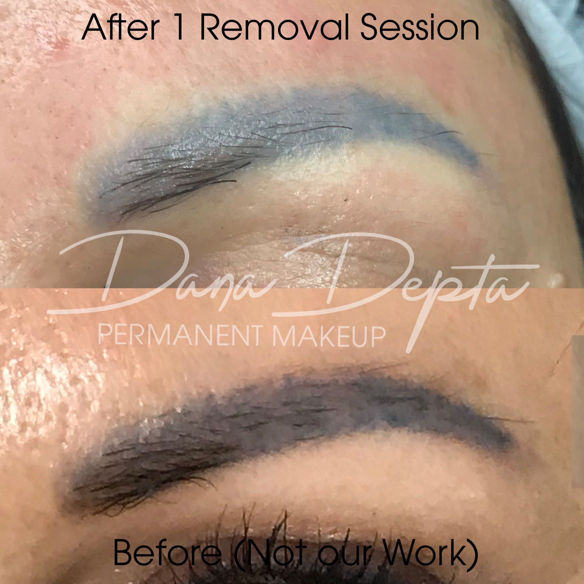 Saline Removal Photos Dana Depta Permanent Makeup