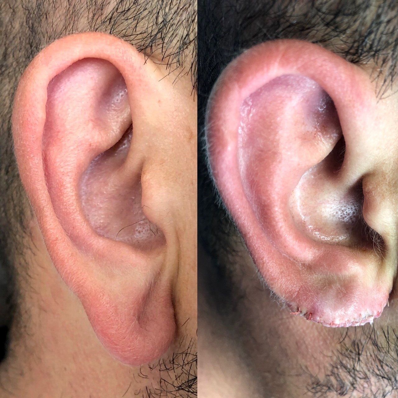 Dr Eric Bonafos Chirurgie Esthétique à Montpellier Ablation des boules de Bichat Chirurgie