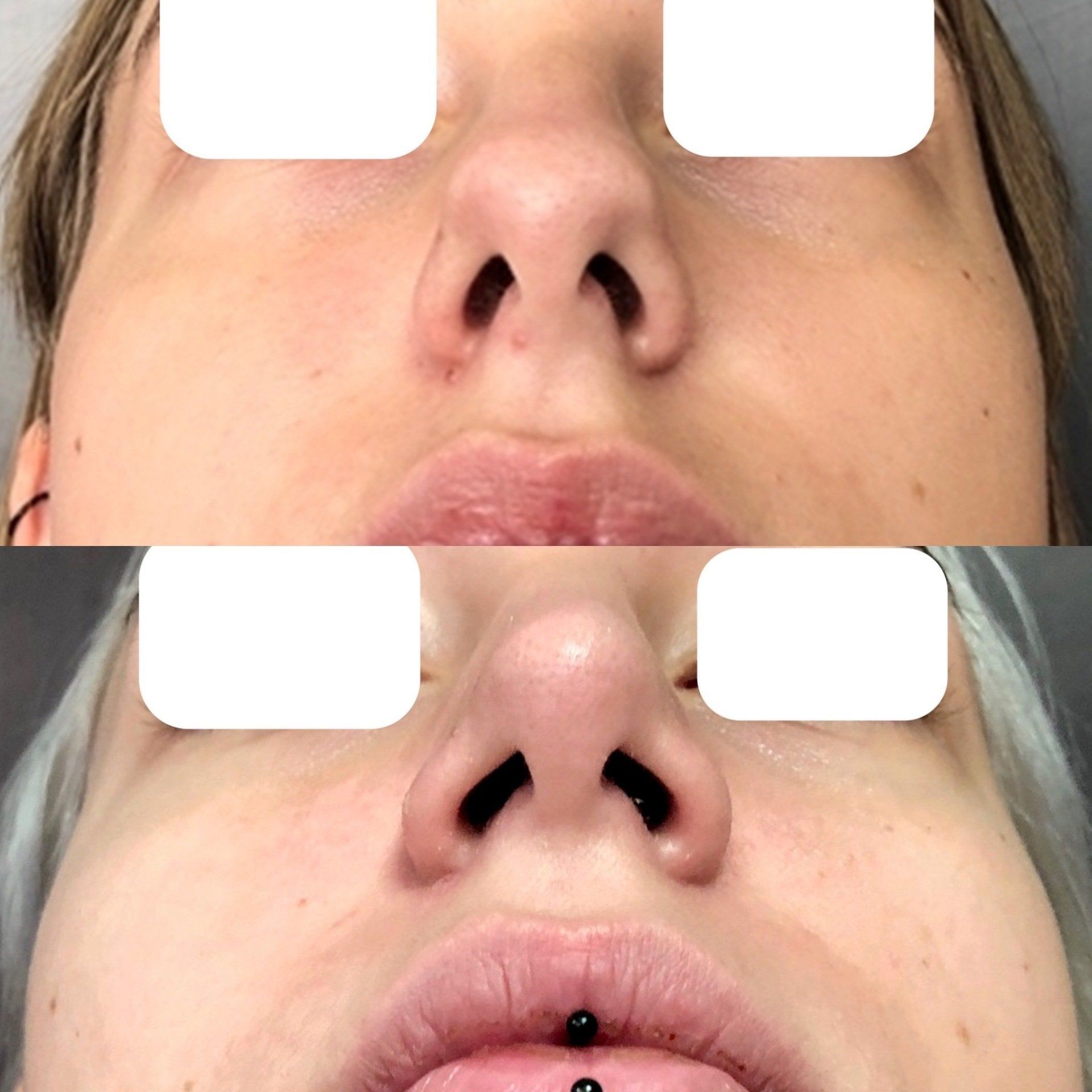 Dr Eric Bonafos Chirurgie Esthétique à Montpellier Ablation des boules de Bichat Chirurgie