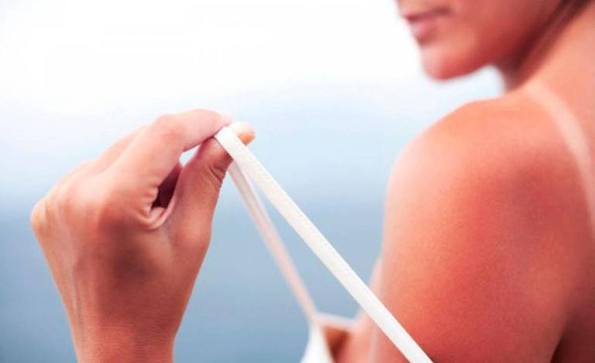 que hacer despues de quemarse con el sol