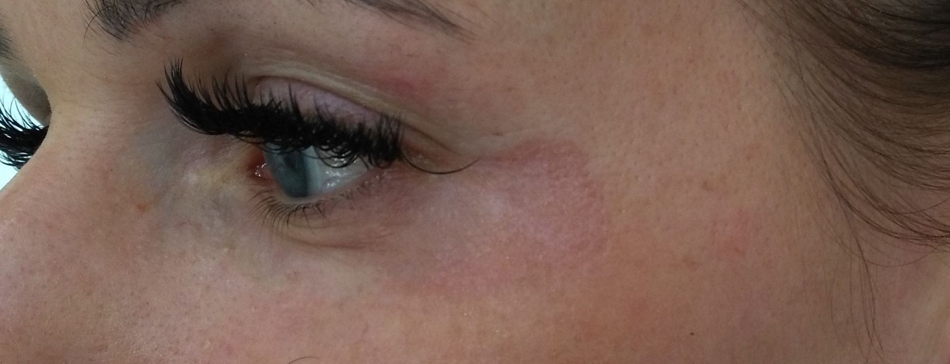 Nach der Plasma Lift Behandlung der Krähenfüße rechtes Auge bei Kosmetik Reichel.