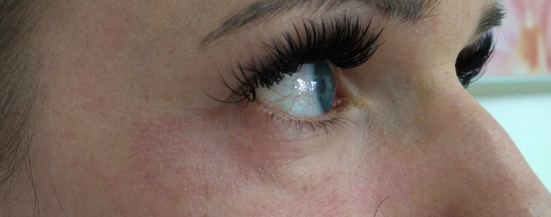 Nach der Plasma Lift Behandlung der Krähenfüße linkes Auge bei Kosmetik Reichel.