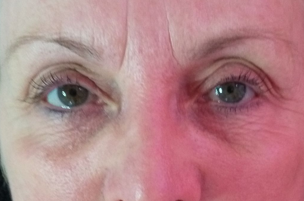 Lider 6 Wochen nach der Plasma Lift Behandlung bei Kosmetik reichel in Dessau.