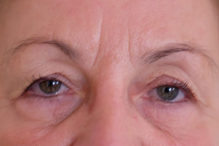 Schlupflider vor der Plasma Pen Behandlung im Kosmetikstudio Reichel.