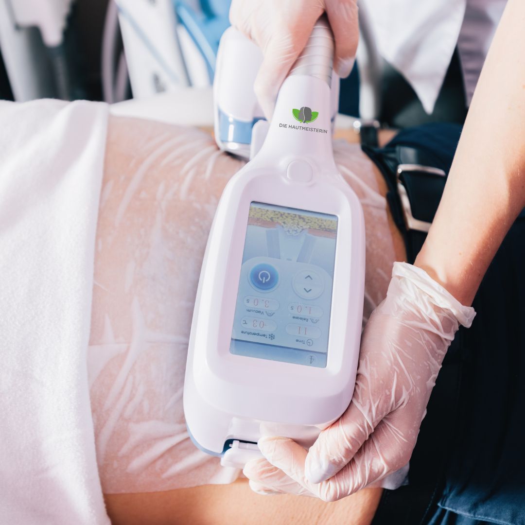 Kryolipolyse in Lüneburg – Fettreduktion durch Kälte für eine schlanke Silhouette.