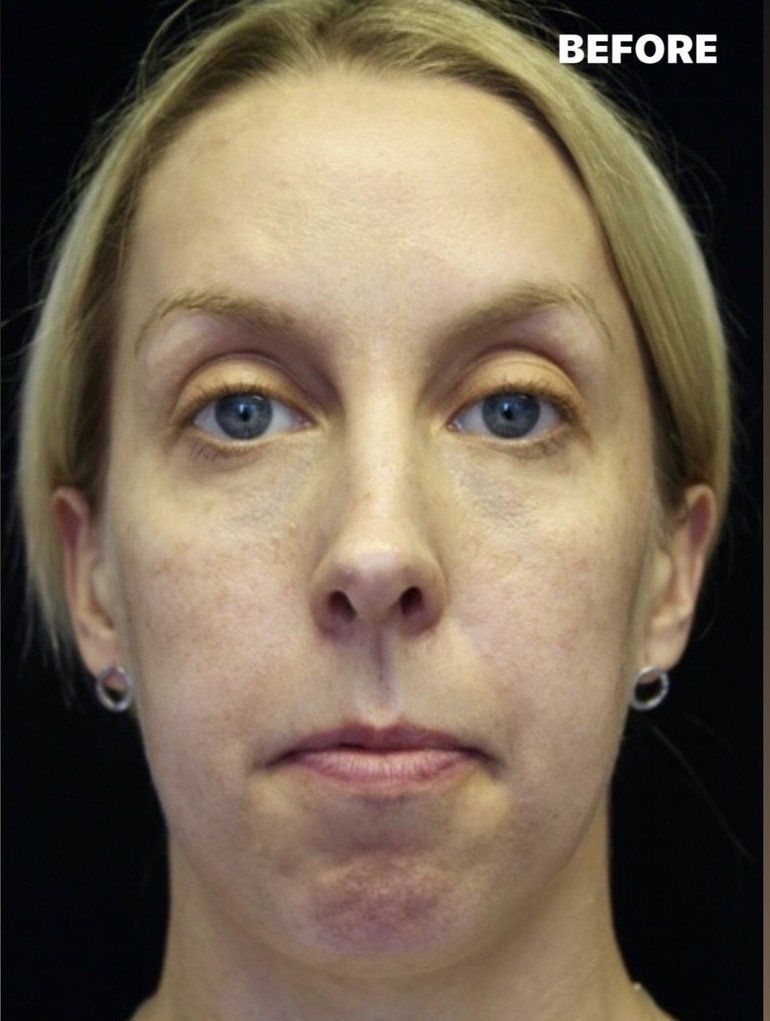 Case study of full face treatment by Dr Ruth Brady