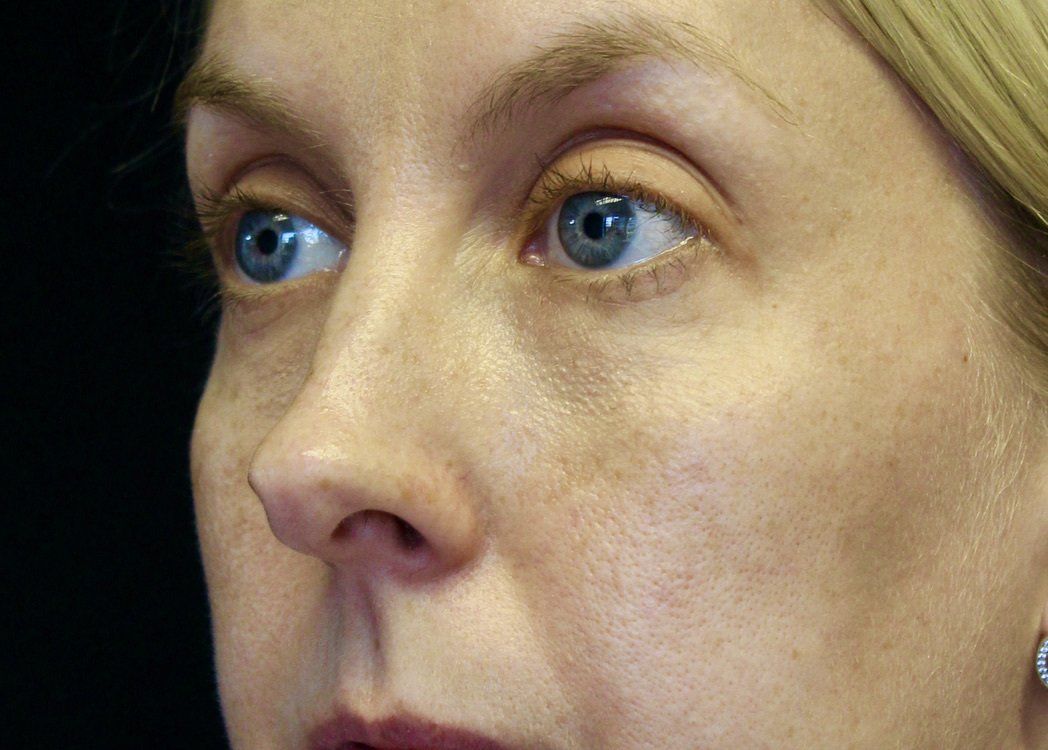 Cheek Augmentation Before PIcture Dr Ruth Brady