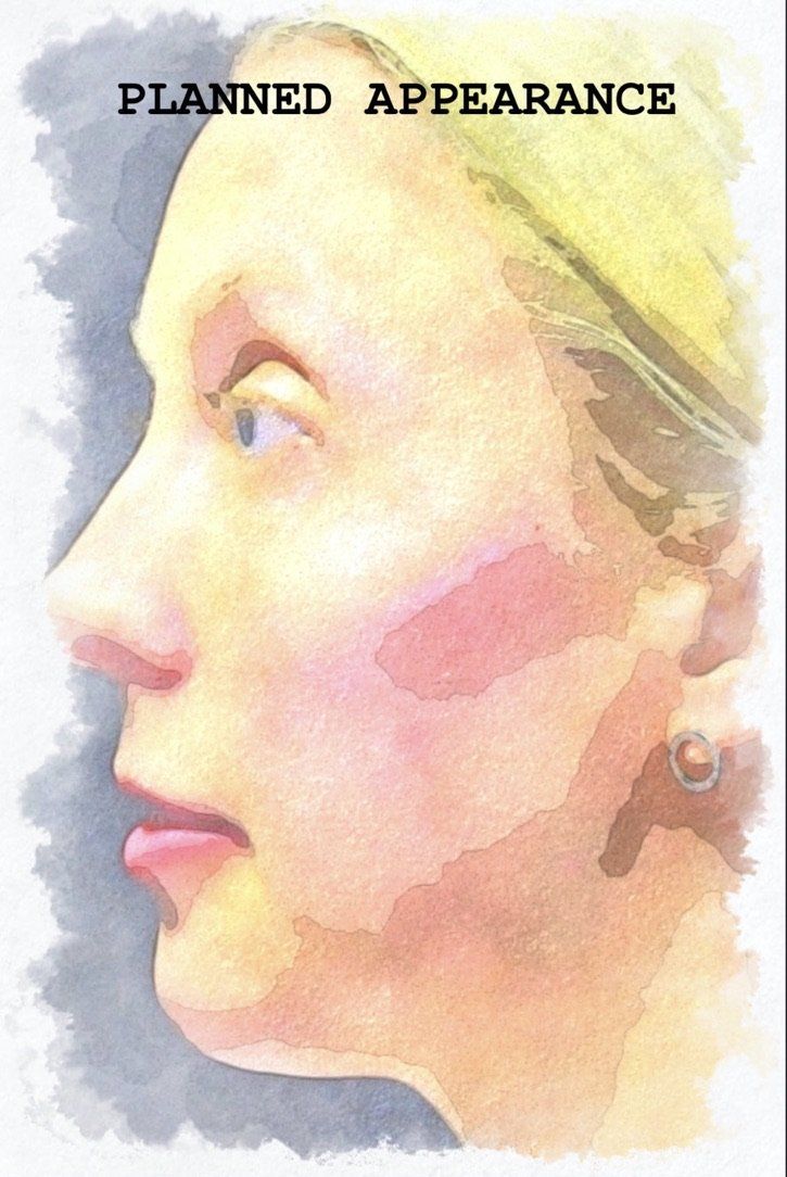 Case study of full face treatment by Dr Ruth Brady