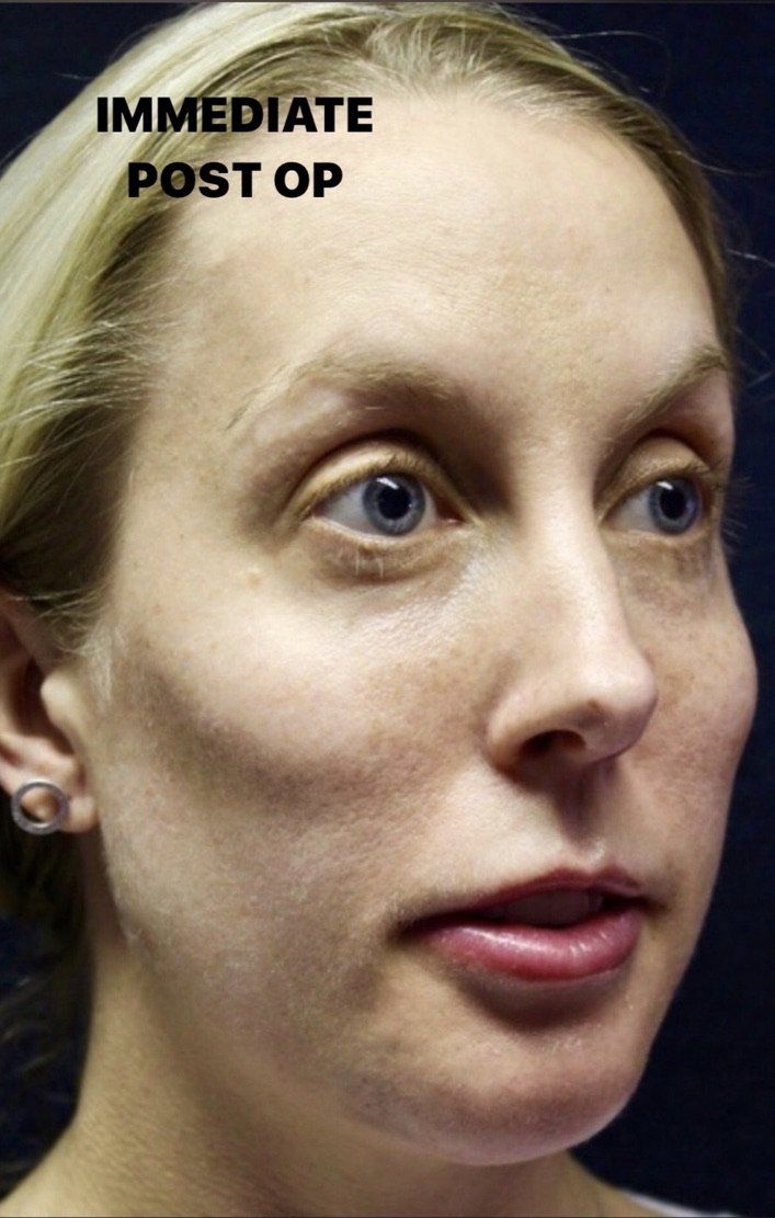 Case study of full face treatment by Dr Ruth Brady