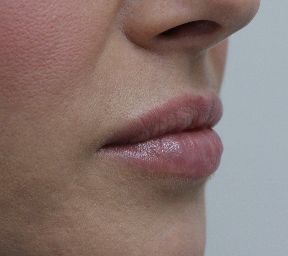Picture of Lips Corrected by Dr Ruth Brady