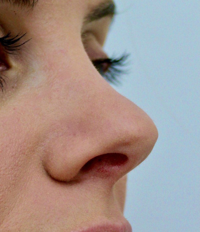 Nose Augmentation Before PIcture Dr Ruth Brady