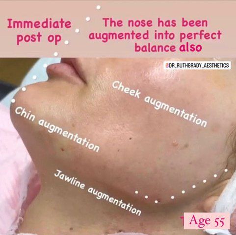 Picture of Chin Corrected by Dr Ruth Brady