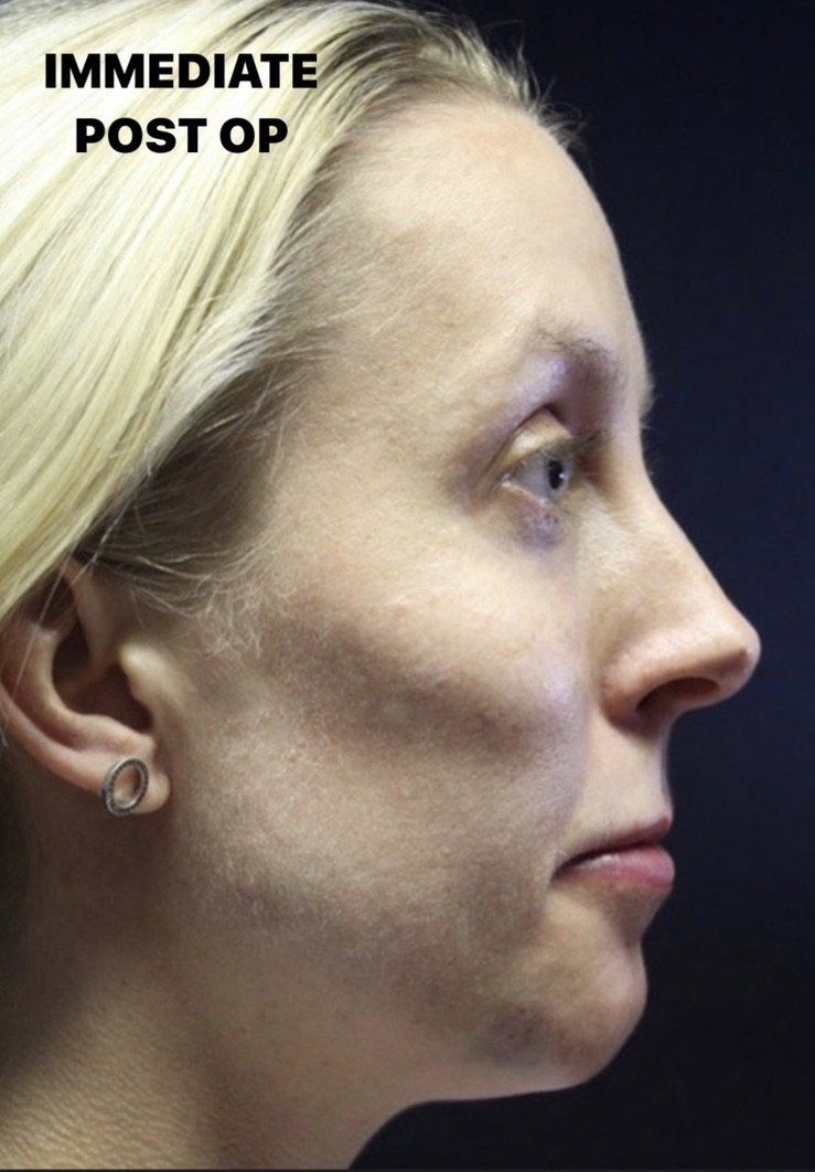 Case study of full face treatment by Dr Ruth Brady