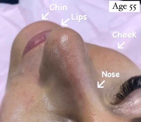 Chin Augmentation Before PIcture Dr Ruth Brady