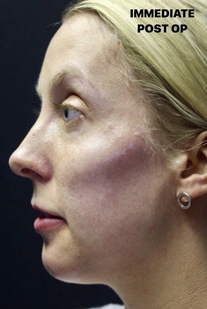 Case study of full face treatment by Dr Ruth Brady