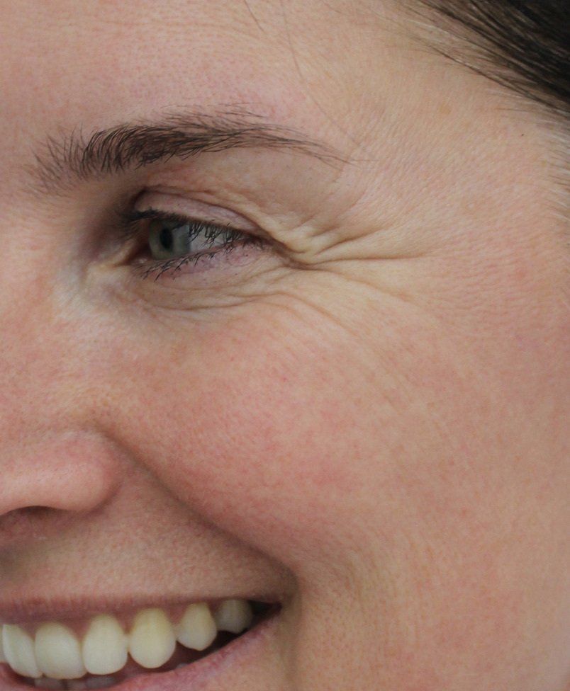 Crows Feet Before Picture Dr Ruth Brady